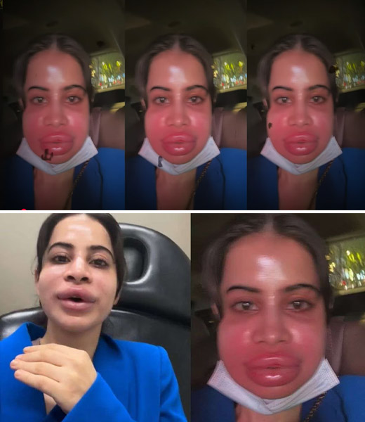 SHOCKING TRANSFORMATION! 😱 Urfi Javed’s Botched Lip Filler & Cosmetic